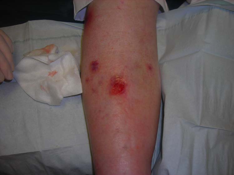 Venous_ulcer_dorsal_leg