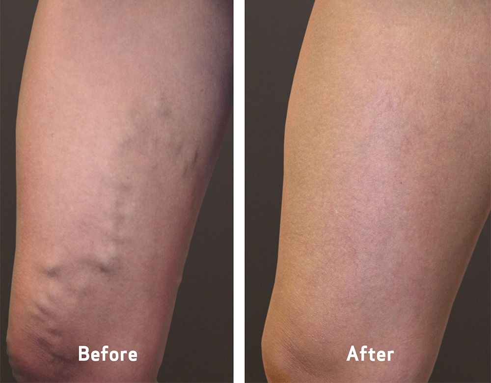vca-before-and-after-varicose-veins-symptoms-home
